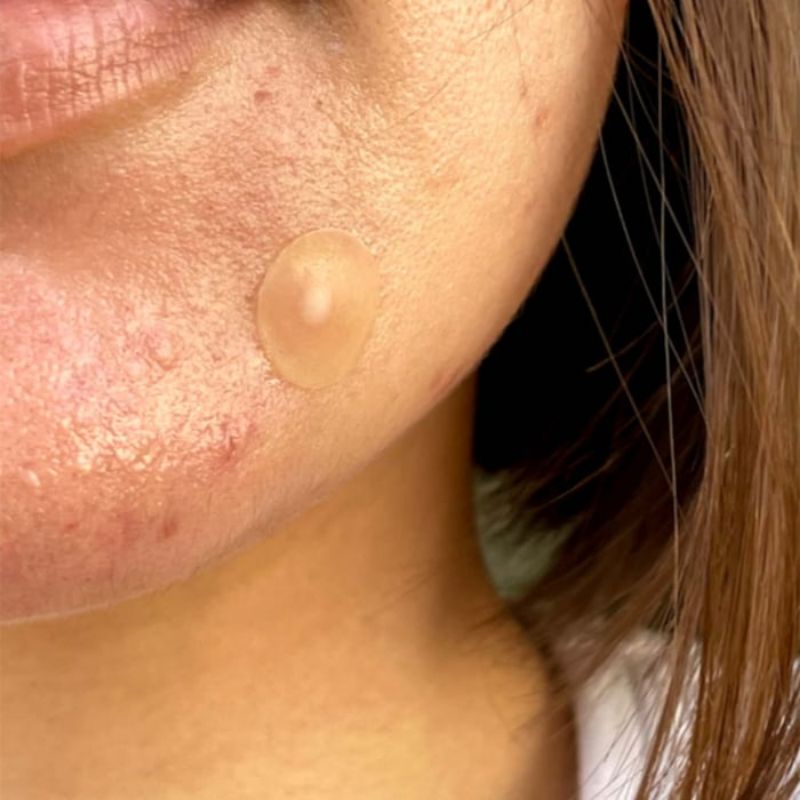 Miếng dán mụn Peace Out Salicylic Acid Acne Healing Dots