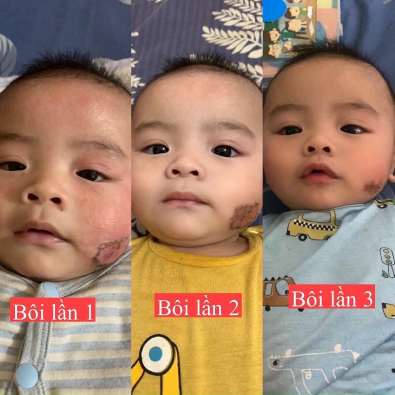 Kem Bôi Da Minh Hùng Chính Hãng - Dưỡng Ẩm Da Bé - Kem Bôi Chàm Sữa, Hăm Tả Mẩn Ngứa