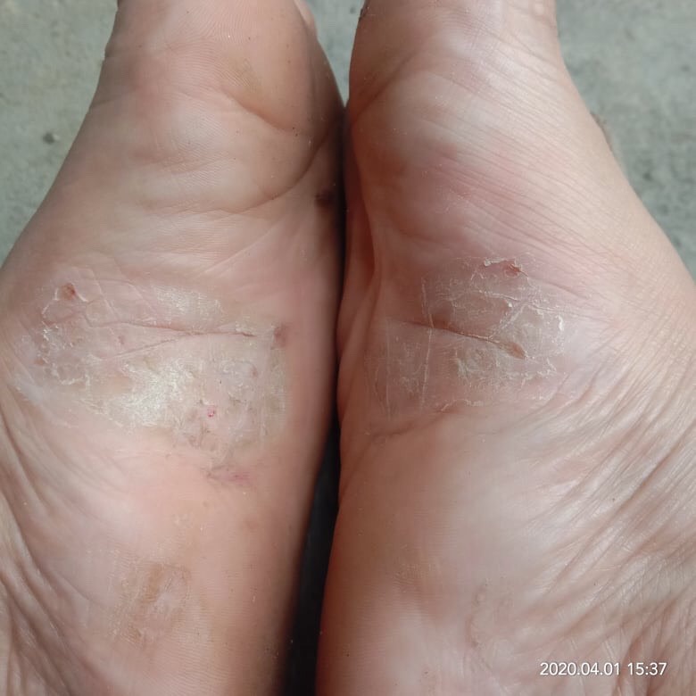 Kem  bôi nấm ngưa hắc lào nấm đau nấm móng