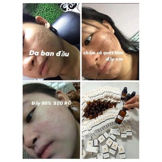 SÉT CHẤM SẸO RỖ TCA 50%