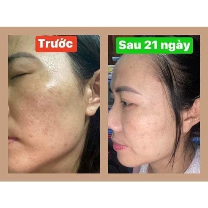 Bộ sản phẩm xoá N.ám , t.àn n.hang , đồi mồi Linh Hương