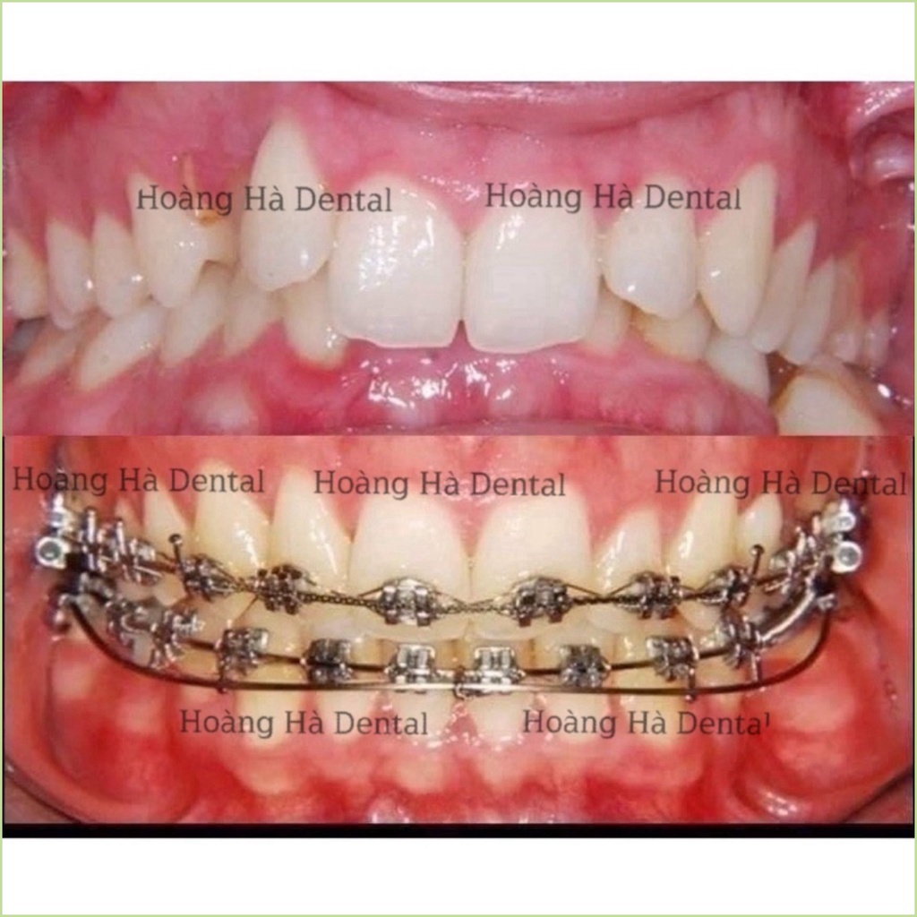 Dây cung đánh lún Dây cung reverse Dây cung ngược niềng răng - NHA KHOA HÀ NỘI