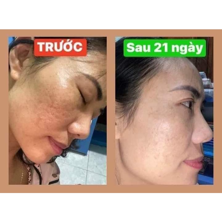 Bộ sản phẩm xoá N.ám , t.àn n.hang , đồi mồi Linh Hương