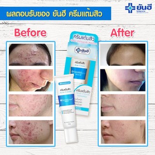 [Chính Hãng] Kem Mụn Acne Cream Yanhee Thailand