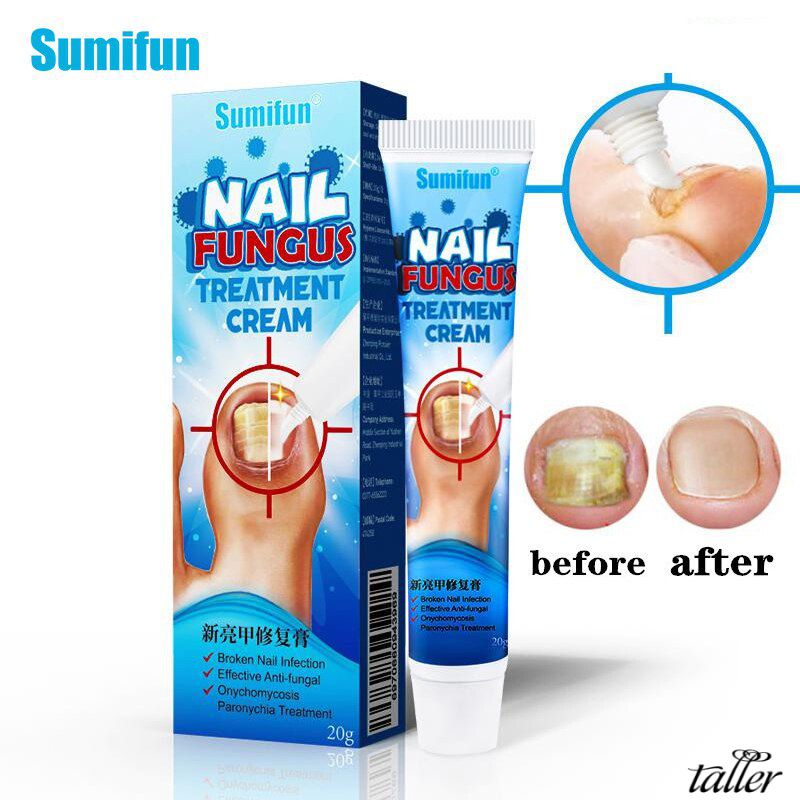 ✧Ready Stcok Sumifun Kem Loại Bỏ Nấm Móng Kem Chăm Sóc Móng Chân Rãnh Móng Tay Điều Trị Bệnh Vẩy Nến Nấm Móng Tay Kem Làm Móng Thực Vật Tự Nhiên Cao Hơn
