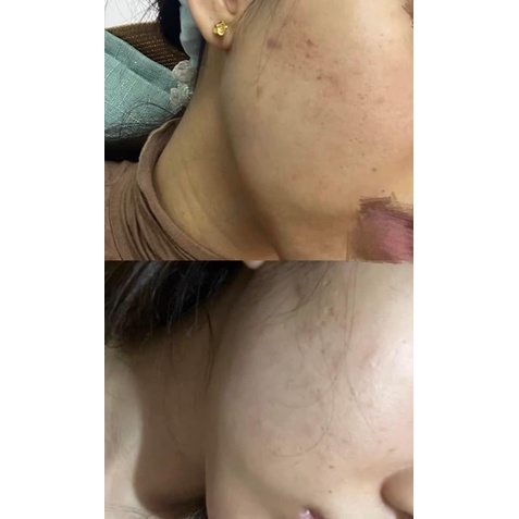 |USED| LASER VI ĐIỂM YDUNVIE