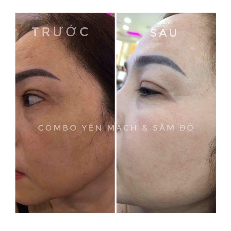 Kem Face Nám SÂM ĐỎ  Ngừa Sạm Nám, Giúp Trẻ Hoá Căng Bóng Da