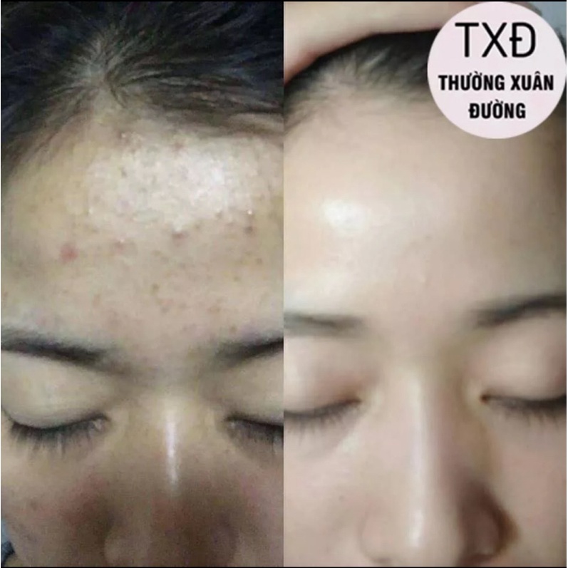 Kem Mụn Hoa Đào nắp đen sạch mụn hết thâm