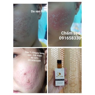 Sét chấm sẹo rỗ tca 50%