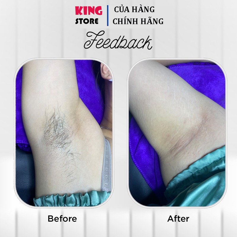 Wax Lông Nóng Cao Cấp King Waxing Wax Lông Nách, Lông Chân, Bikini Siêu Sạch.