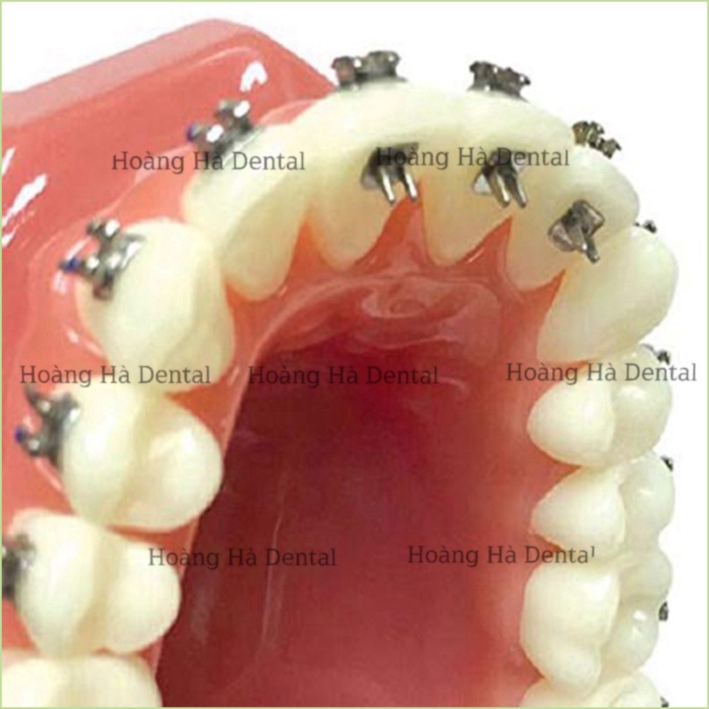 10 Nút dán chặn đẩy lưỡi chỉnh nha - NHA KHOA HÀ NỘI