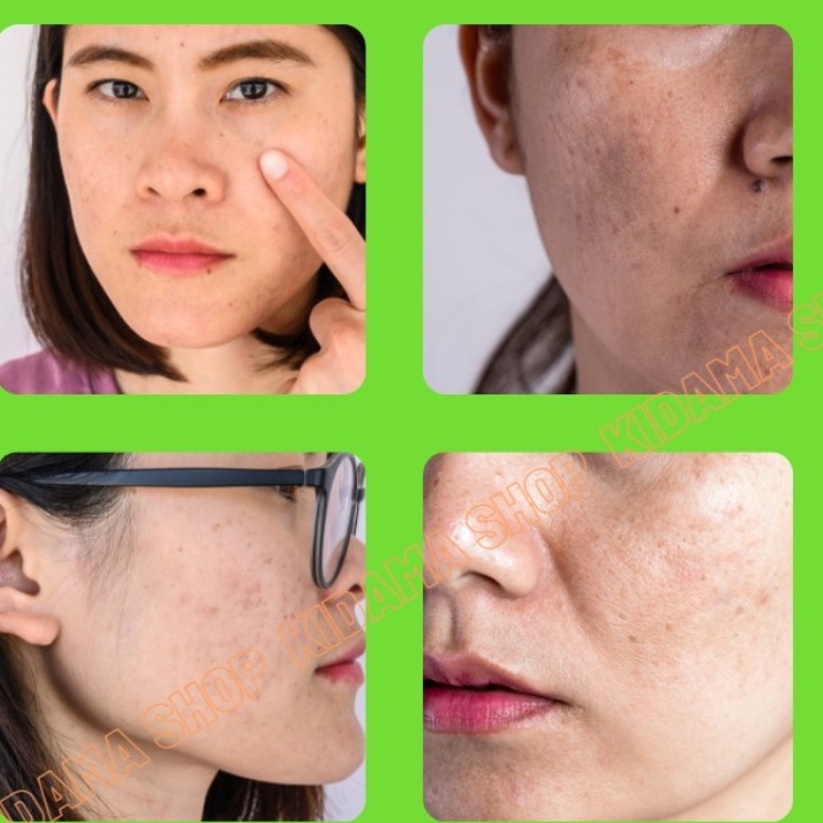 Kem nám tàn nhang K7 Da Liễu CANOVA 8+2 và Depi 50+ giảm thâm nám dưỡng da chậm lão hóa, Nhập khẩu Ý