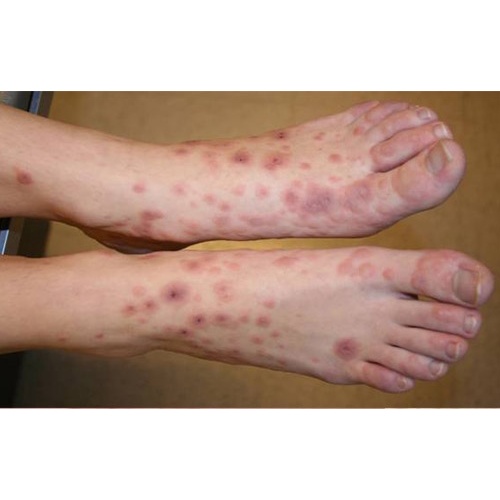 Serum dưỡng ngừa thâm chân tay ,nách bẹn mông 15ml