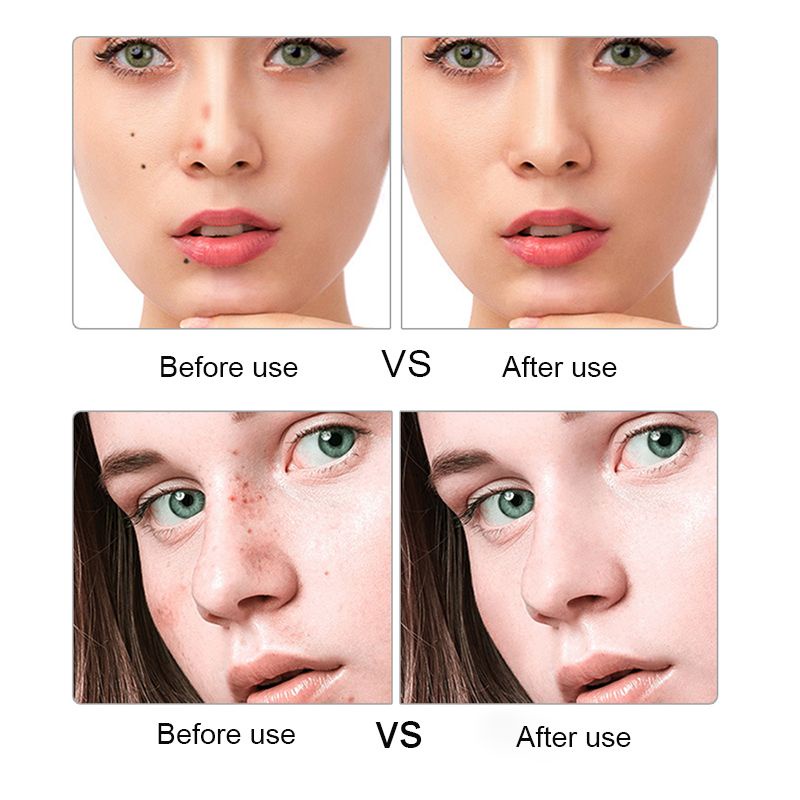 Bút Laser Plasma Xóa Tàn Nhang / Nốt Ruồi / Mụn / Hình Xăm Tiện Dụng