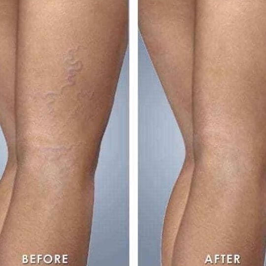 Kem Bôi Giãn Tĩnh Mạch Abtei Venen Aktiv Đức Giãn Cải Thiện Giãn Tĩnh Mạch Chân Giup Lưu Thông Máu 125ml