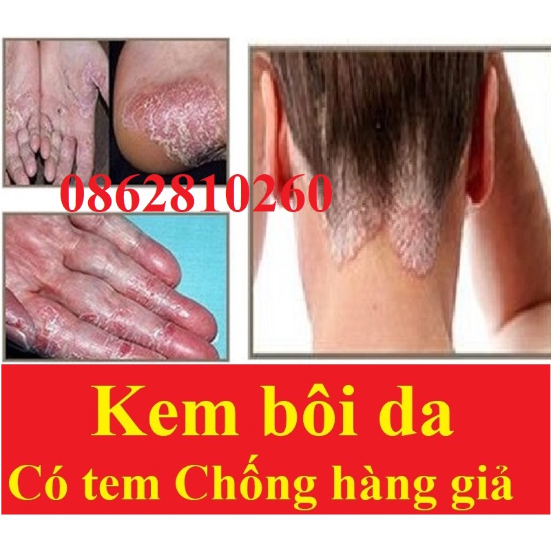Kem bôi ngoài da hỗ trợ nấm ngứa, chàm, tổ đỉa, ghẻ nước...