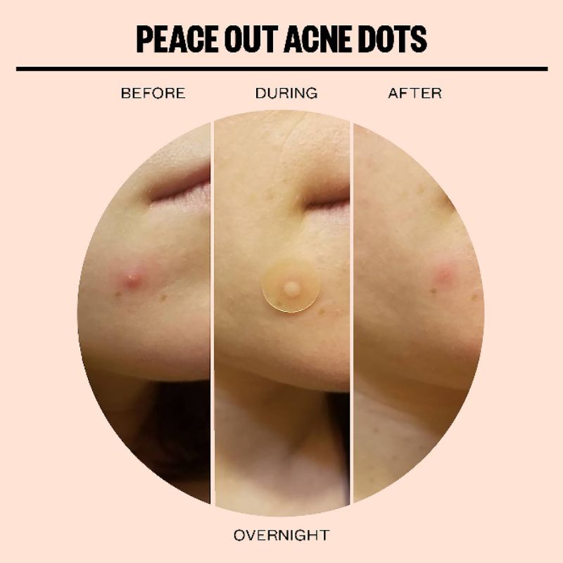 Miếng dán mụn Peace Out Salicylic Acid Acne Healing Dots