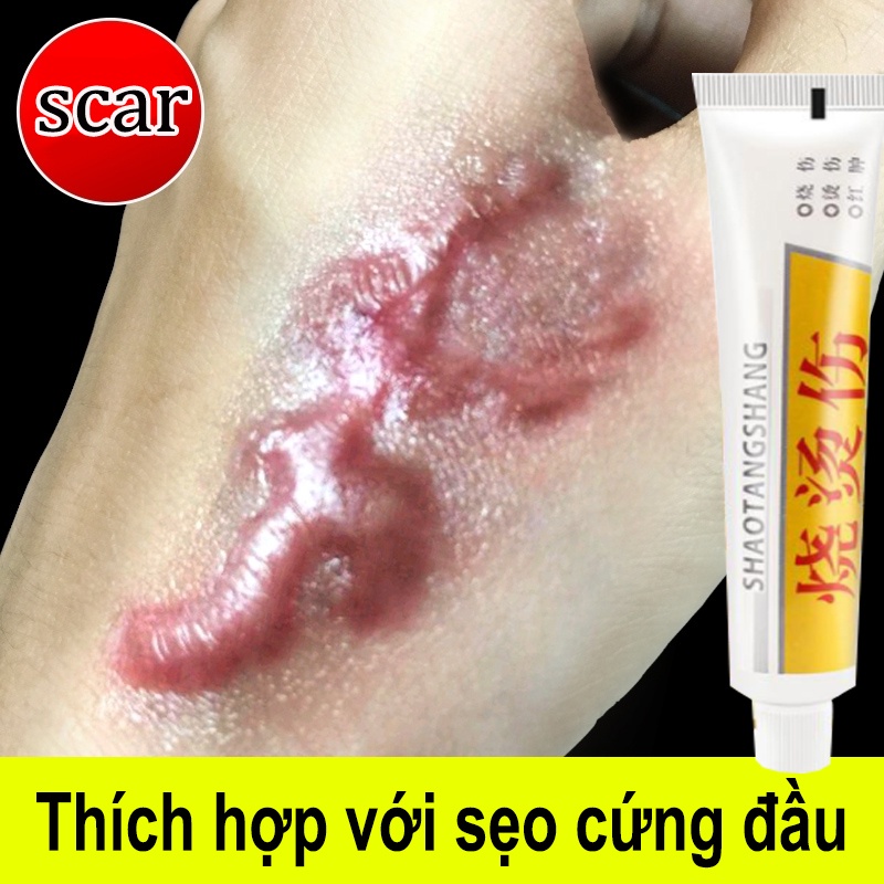 Kem sẹo Kem làm mờ sẹo cho da đốt cháy bỏng nước kem loại bỏ sẹo lồi Kem sẹo chuyên dùng cho trẻ em 25g