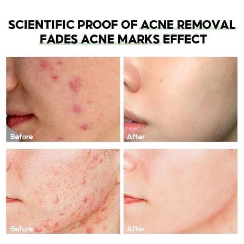 Kem Giảm Mụn Mờ Thâm Làm Trắng Da Acne Derm 20% Axit Azelaic 20g