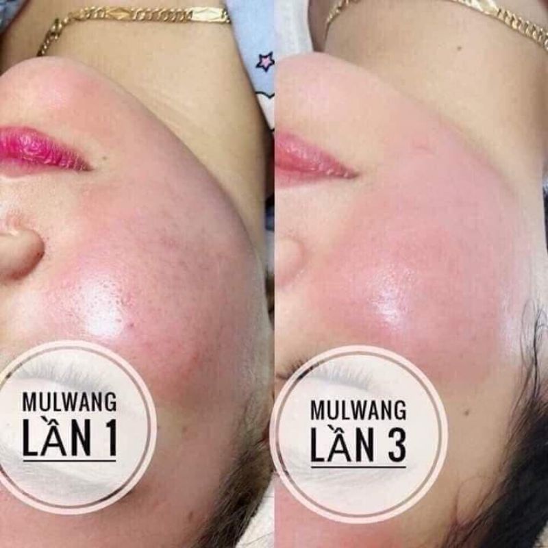 Căng bóng trẻ hoá Mulwang Black Hàn Quốc