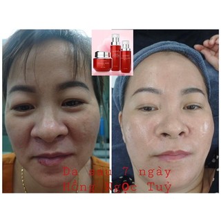 BỘ HỒNG NGỌC TUỶ RAVIS ( chính hãng )