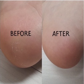 Kem dưỡng giảm nứt gót chân DERMA:B UREA 9.8 FOOT CREAM