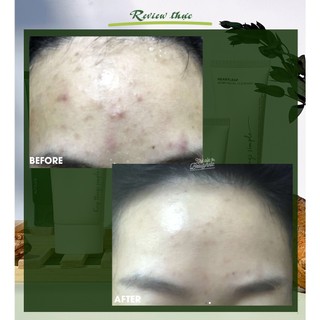 Bộ dưỡng diếp cá ANUA HEARTLEAF