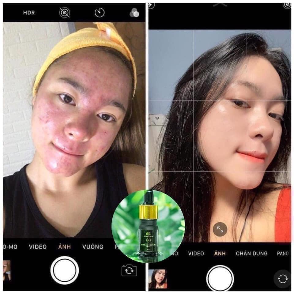 Ngừa mụn không sưng  Sake Magic Skin CHÍNH HÃNG