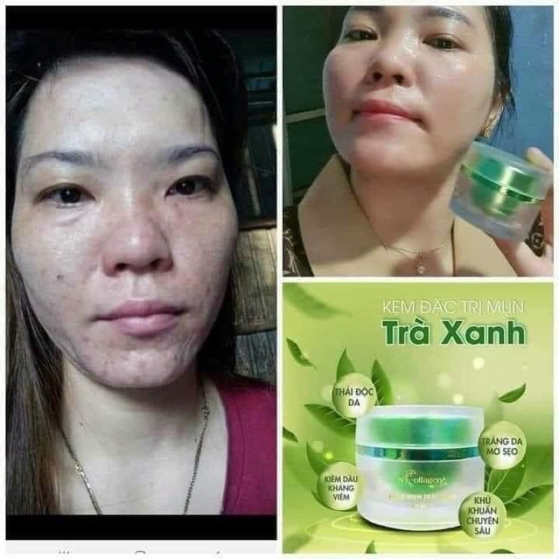 Kem Face Mụn Trà Xanh Ncolagen