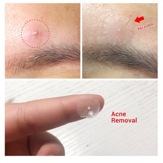 Miếng dán mụn Lanbena Breylee Acne Pimple Patch