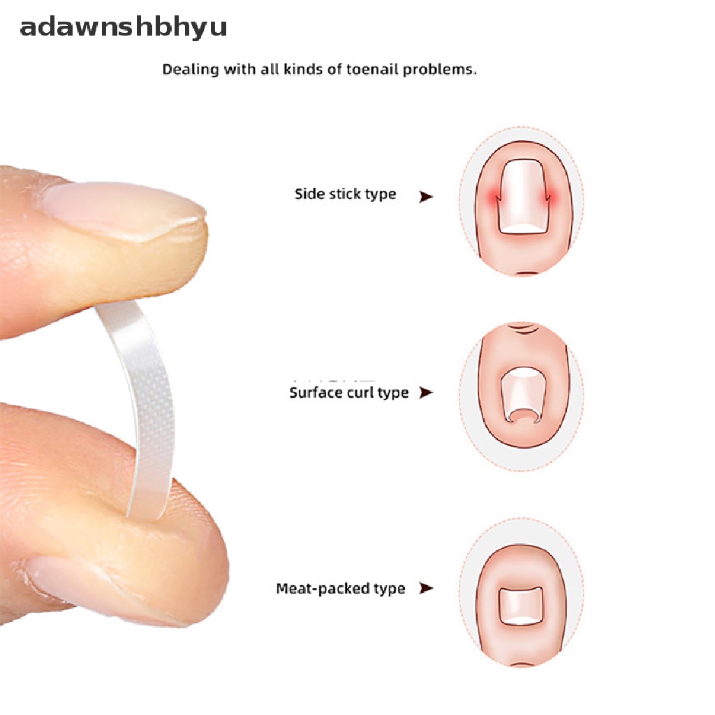 Set 10 Miếng Dán Đàn Hồi Chỉnh Sửa Móng Chân Mọc Ngược adawnshbhyu