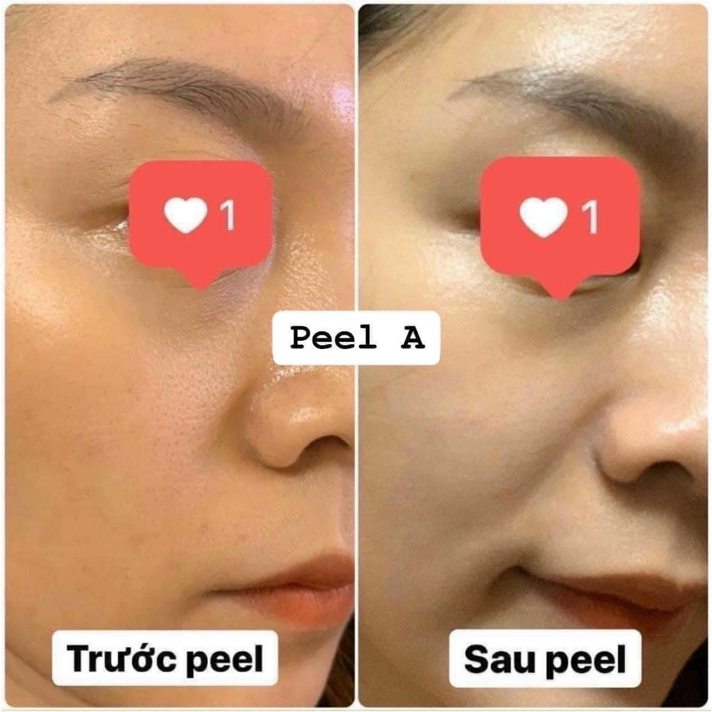 Peel da Inno Aesthetics Exfo Lightening