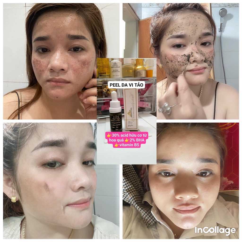 Peel da vi tảo Chamomileskill - Ampoule Peel nho đen chính hãng giúp làm da mịn màng và trắng sáng hơn