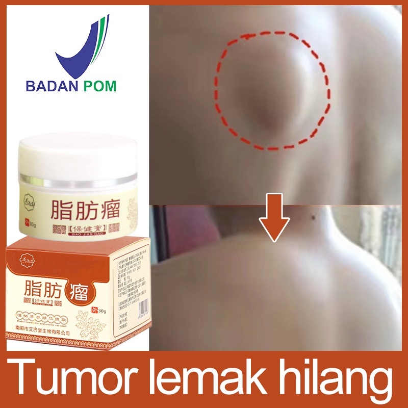 kem loại bỏ u mỡ tan u mỡ Trung Quốc kem giảm đau ngón tay cổ tay giảm đau thần kinh gân khớp