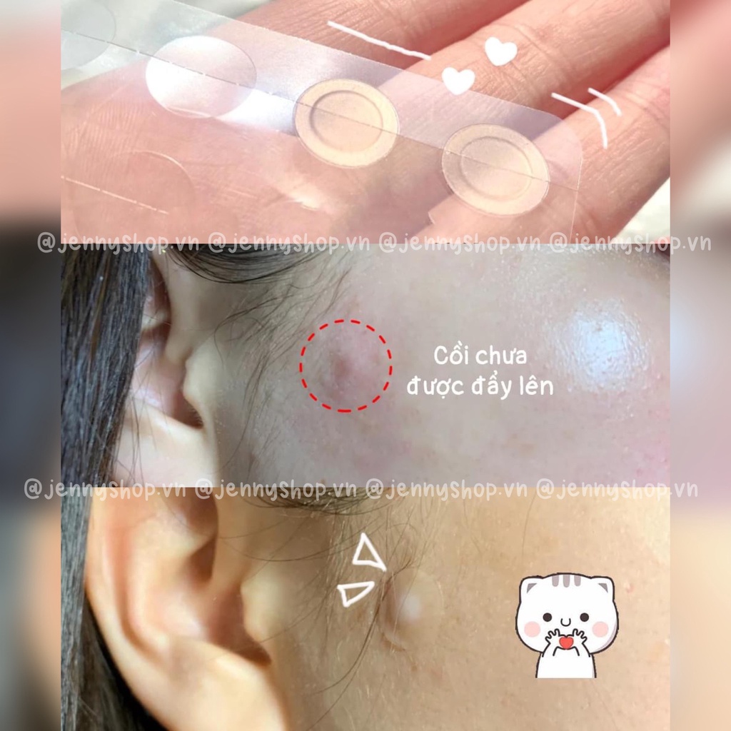 Miếng Dán Mụn Some By Mi Clear Spot Patch