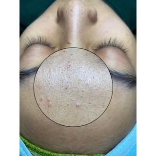 SERUM CHẤM MỤN  DƯỠNG DA HANDMADE