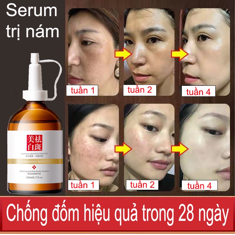 kem trị nám serum trị nám100ML Làm sáng các đốm làm trắng dưỡng ẩm trì hoãn lão hóa Làm sáng màu da