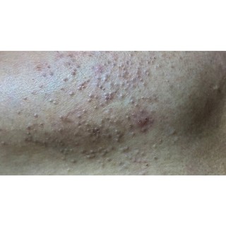 SERUM CHẤM MỤN  DƯỠNG DA HANDMADE