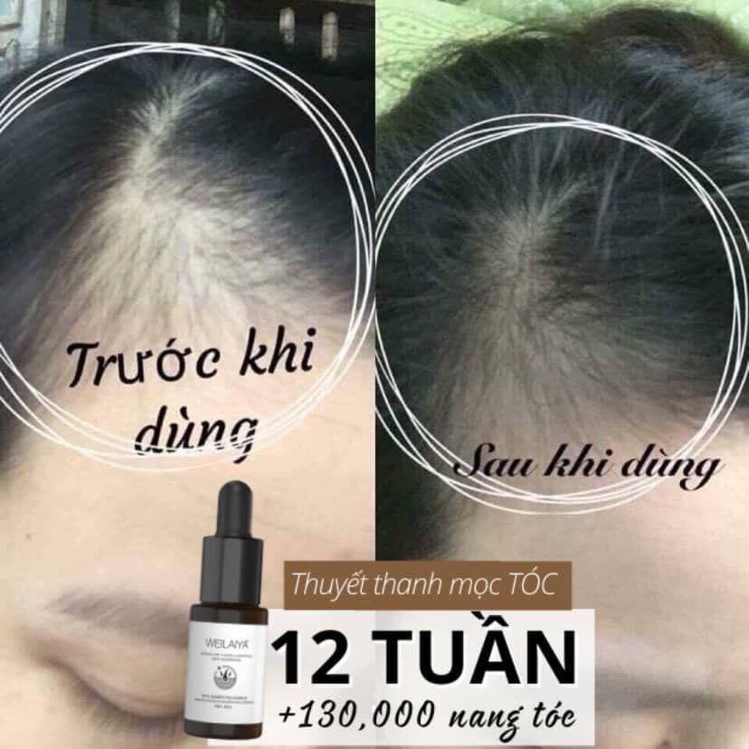 Serum huyết thanh kích mọc và làm dày tóc weilaiya