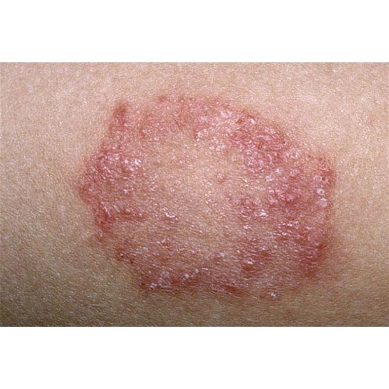 Kem bôi hắc lào nấm đầu ghẻ nước nấm móng tay chan