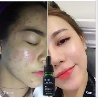 Serum giảm mụn mờ thâm BH 10ml