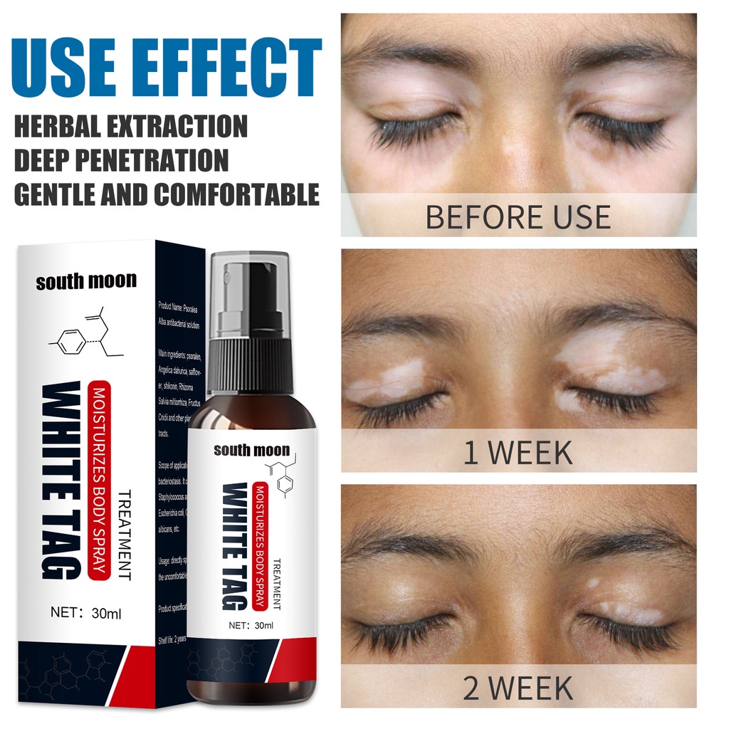 Kem vitiligo Kem vitiligo Loại Bỏ vitiligo Hỗ Trợ Giảm vitiligo