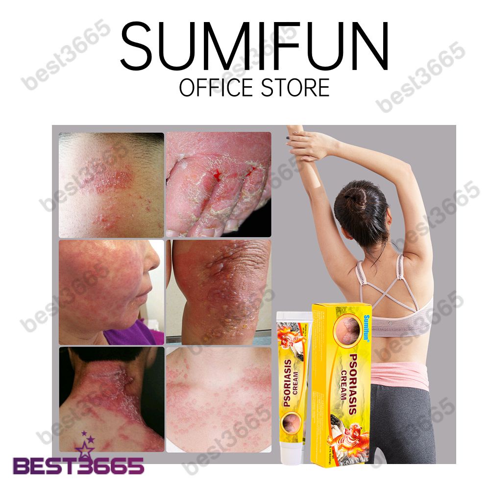 Kem Chống Ngứa 20G Thuốc Mỡ Trị Chàm, Hắc Lào, Phát Ban, Muỗi Đốt, Chiết Xuất Thực Vật, Có Thể Dùng Cho Toàn Thân • Best3665