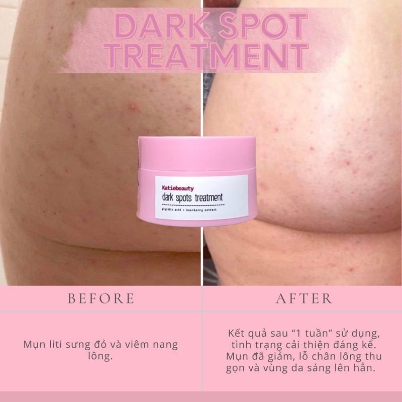 Kem thoa thâm Mông, mụn Mông, Bẹn, Nách, Lưng, Cùi chỏ, Đầu gối  Dark spot lotion