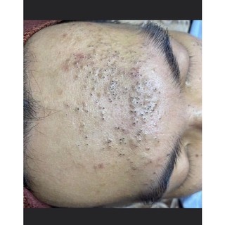 SERUM CHẤM MỤN  DƯỠNG DA HANDMADE