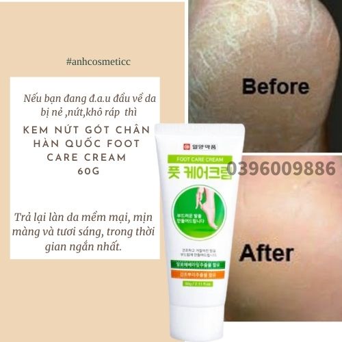 Kem nẻ gót chân yougreen F oint 60g Hàn Quốc Chính Hãng / Kem dưỡng và giảm nứt gót chân Foot Care Cream