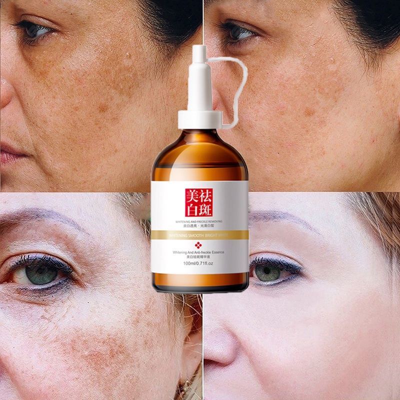 Tinh chất làm trắng sạch tàn nhang 100ml Kem trắng da và xóa tàn nhang, Hiệu quả làm mờ thâm nám tàn nhan, kem thâm nám