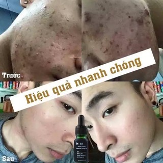 Serum giảm mụn mờ thâm BH 10ml