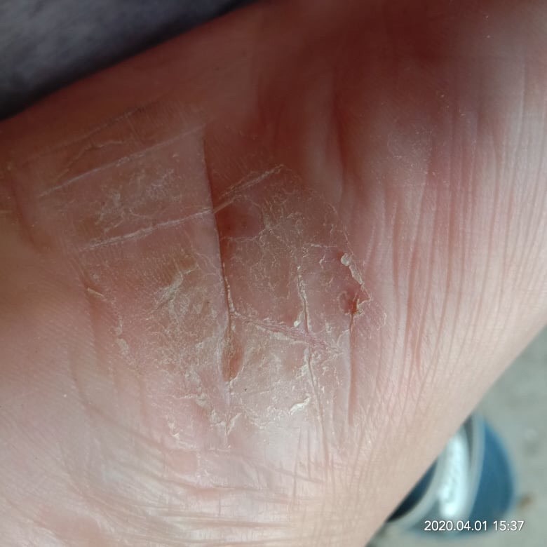 Kem bôi hắc lào nấm đầu ghẻ nước nấm móng tay chan