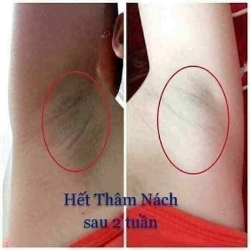 Kem thâm nách QNic Thái Lan - chính Hãng